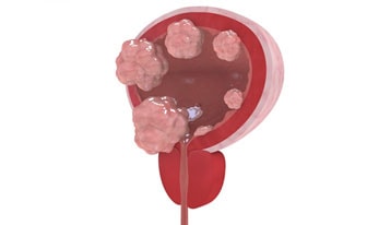 Aggressive Bladder Cancer